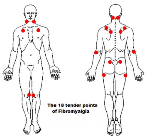 18 Tender Points of Fibromyalgia