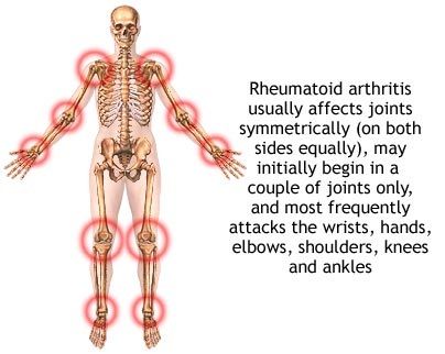 Joints affected by Arthritis
