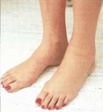Pregnant Woman’s Feet Swollen from Edema