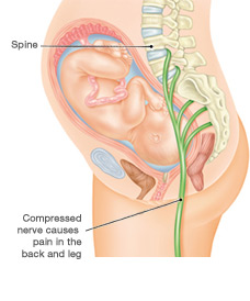 Fetus in Uterus Compressing Sciatic Nerve