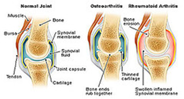 Normal Joint and Joints with Rheumatoid and Osteoarthritis